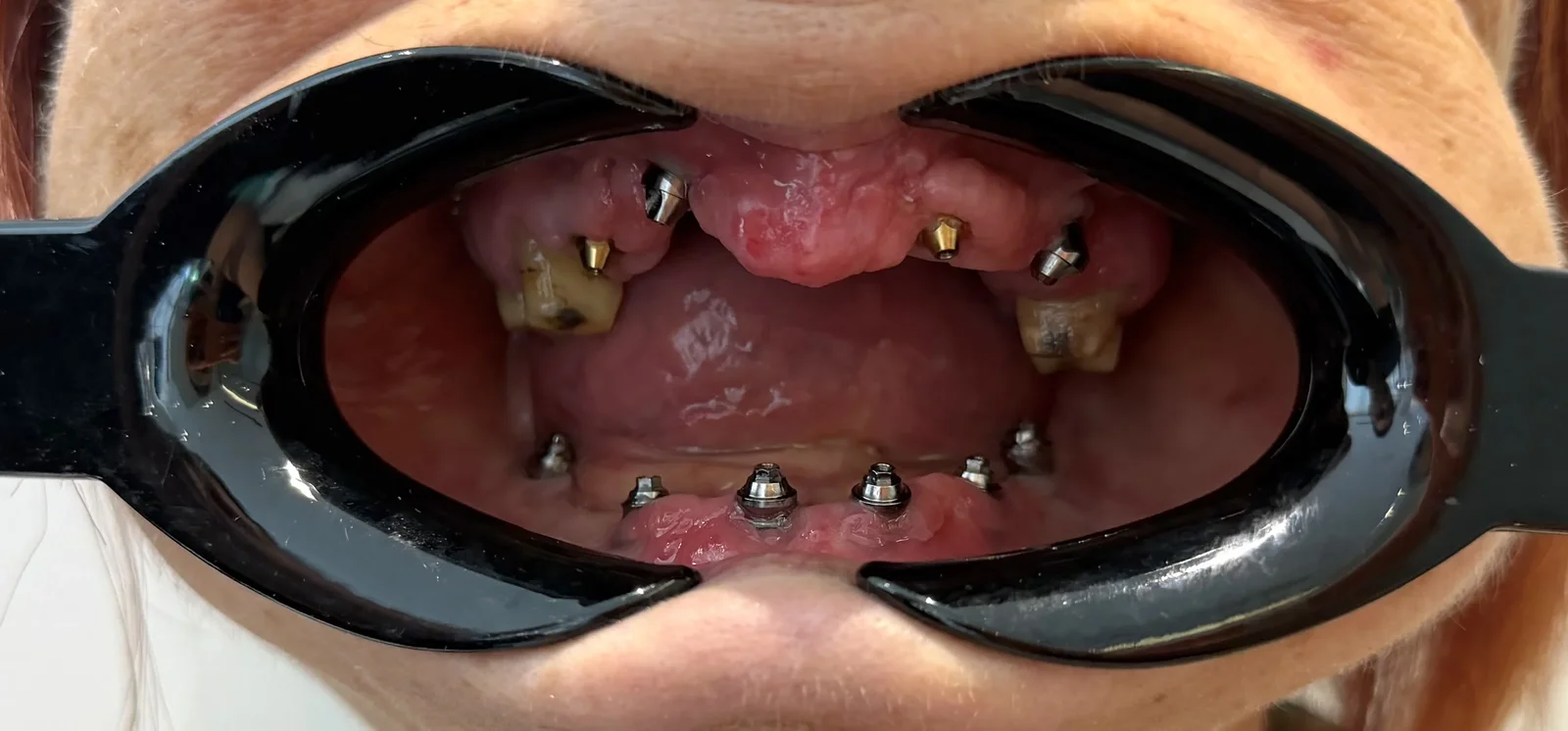 Dental Implants: What They Are, Benefits, and Who Can Get Them
