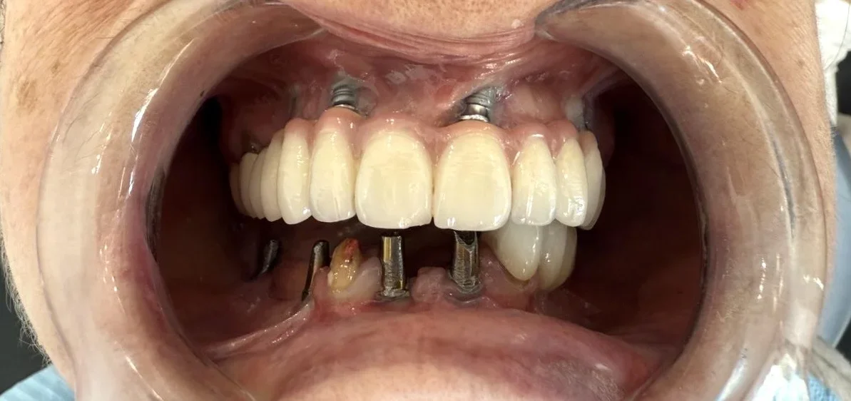 Full-Mouth Implant Rehabilitation After All-on-4 Failure Due to Peri-Implantitis