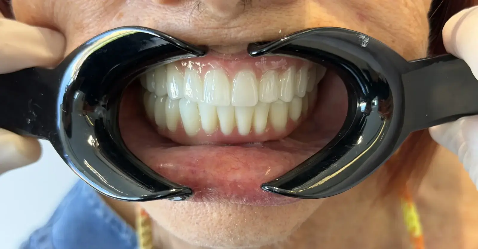 Full-mouth implant rehabilitation final result