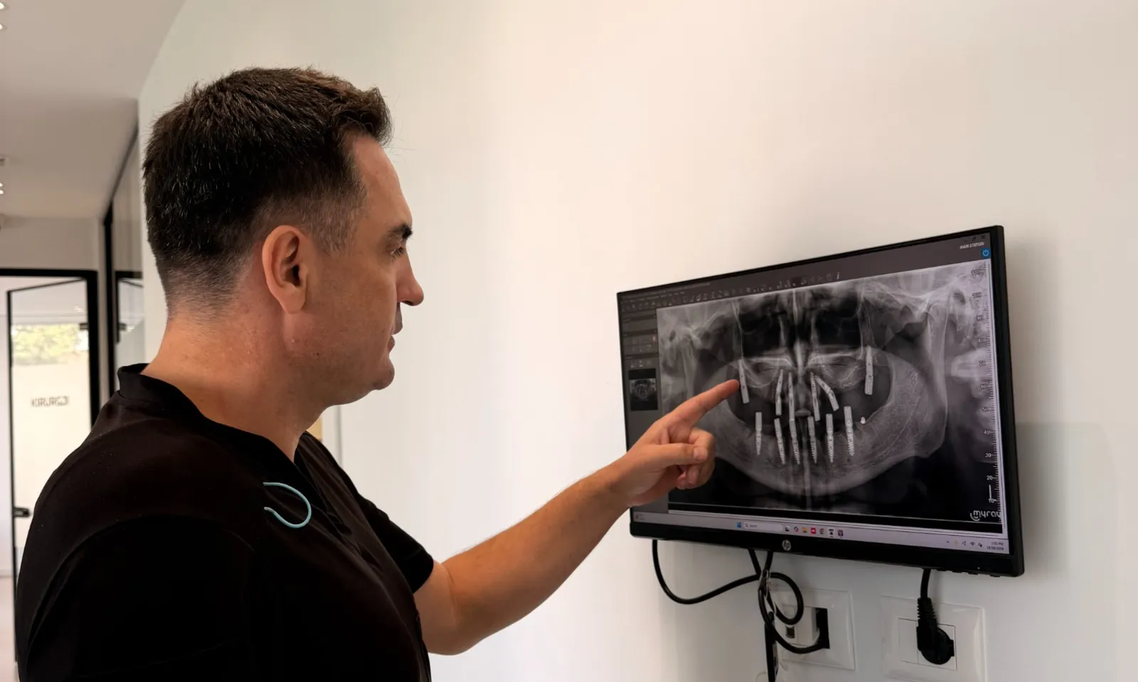 Pterygoid implants: an option for upper-jaw bone loss