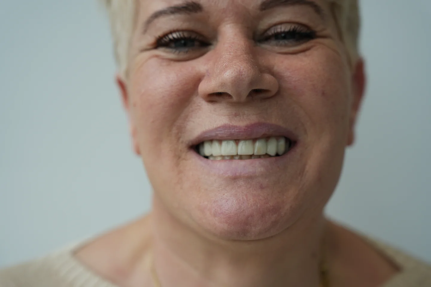 Dopo - Dental implant case 1
