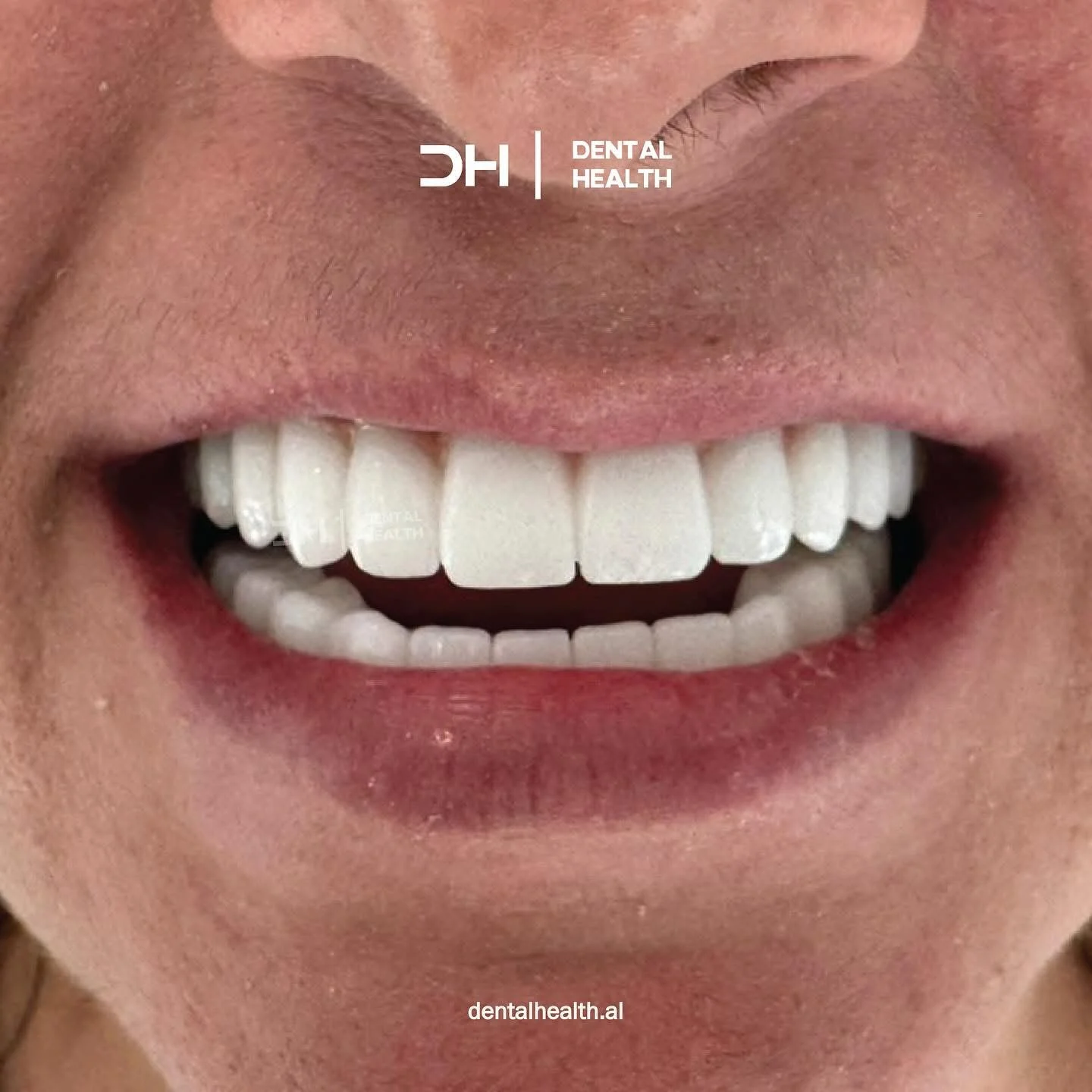 Dopo - Dental implant case 3