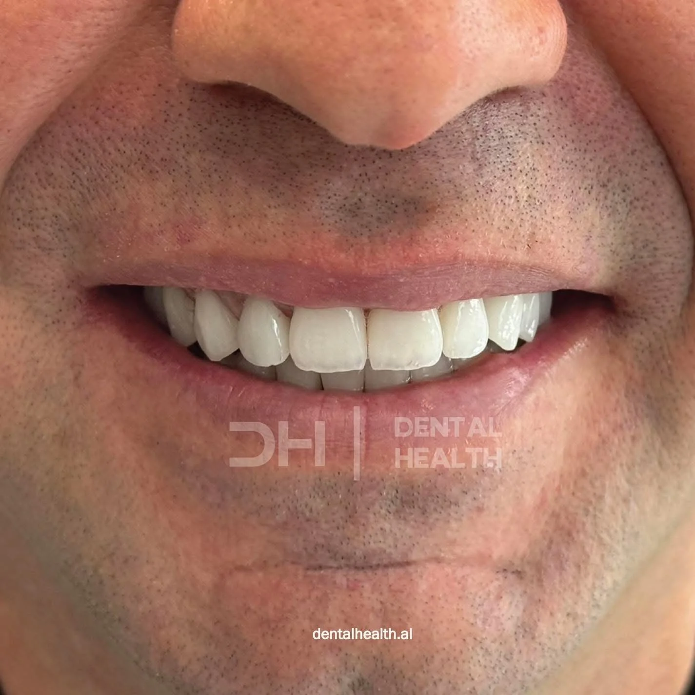 Dopo - Dental implant case 4