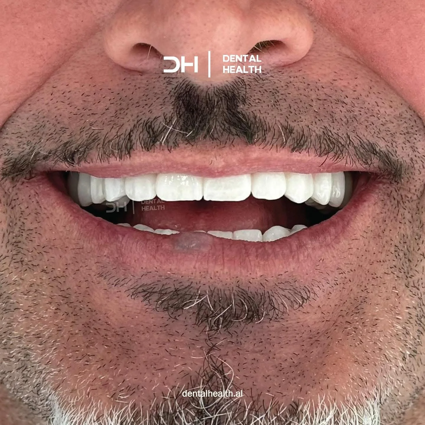 Dopo - Dental implant case 5