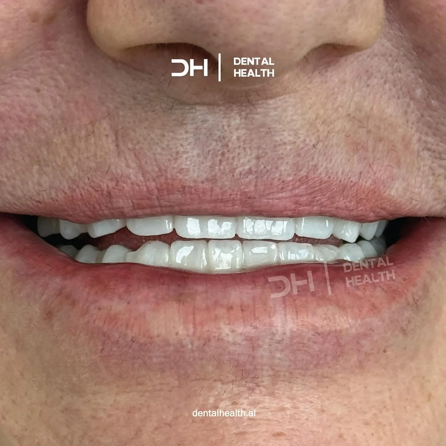 Dopo - Dental implant case 6