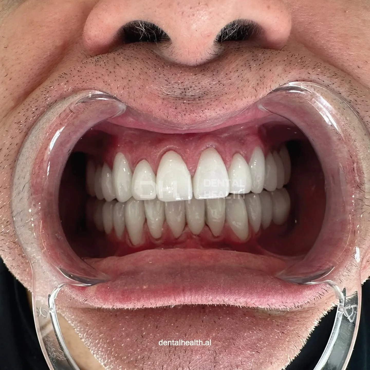 Dopo - Dental implant case 7