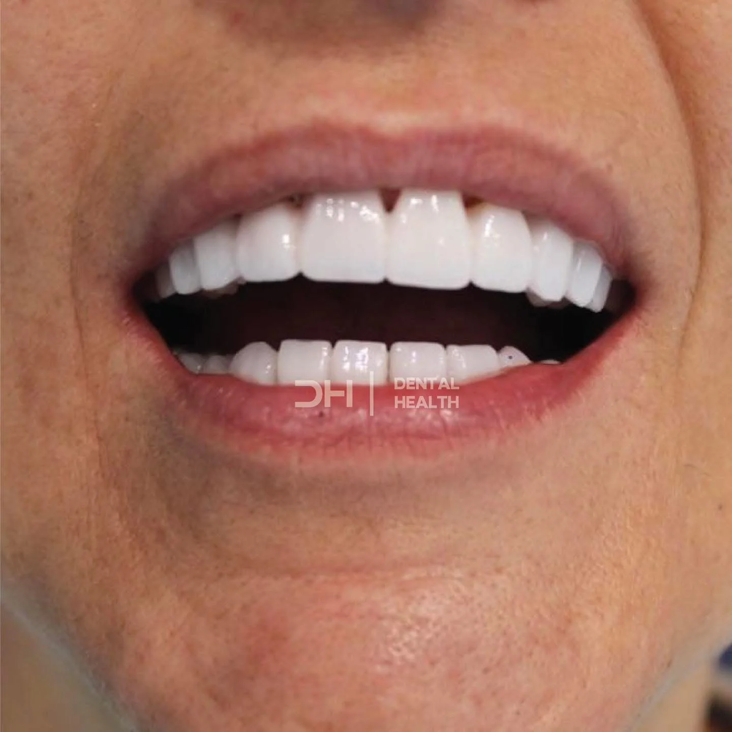 Dopo - Dental implant case 8