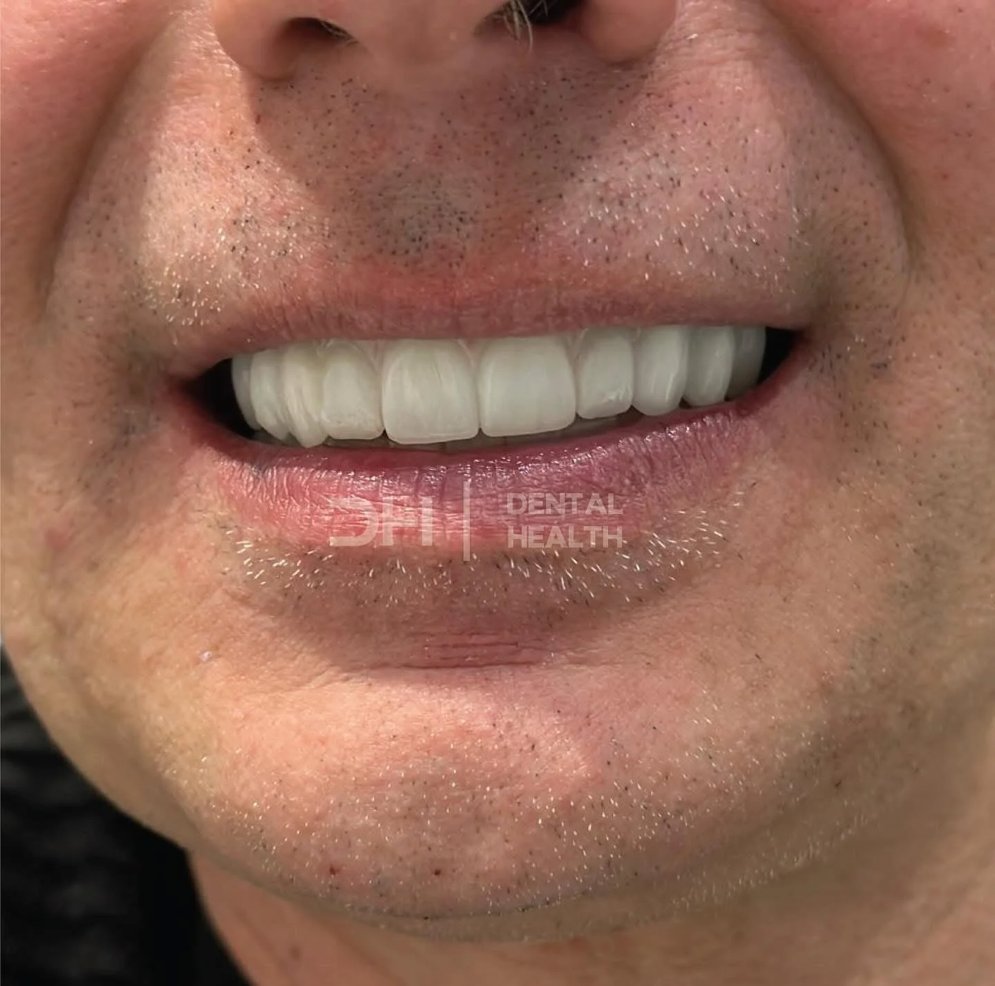 Dopo - Dental implant case 9
