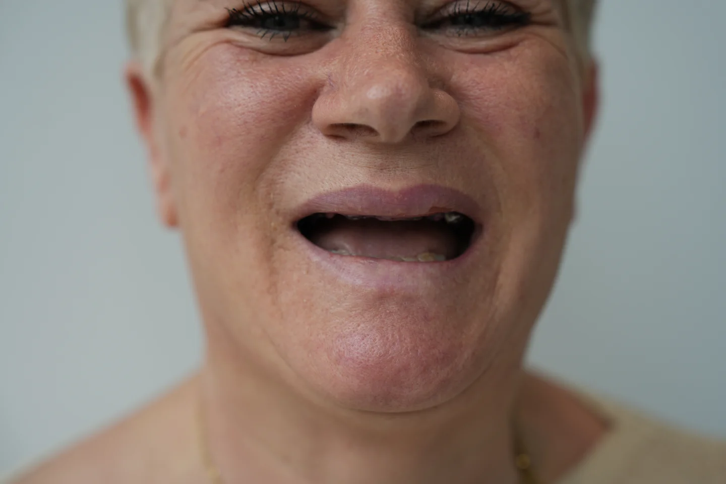 Prima - Dental implant case 1