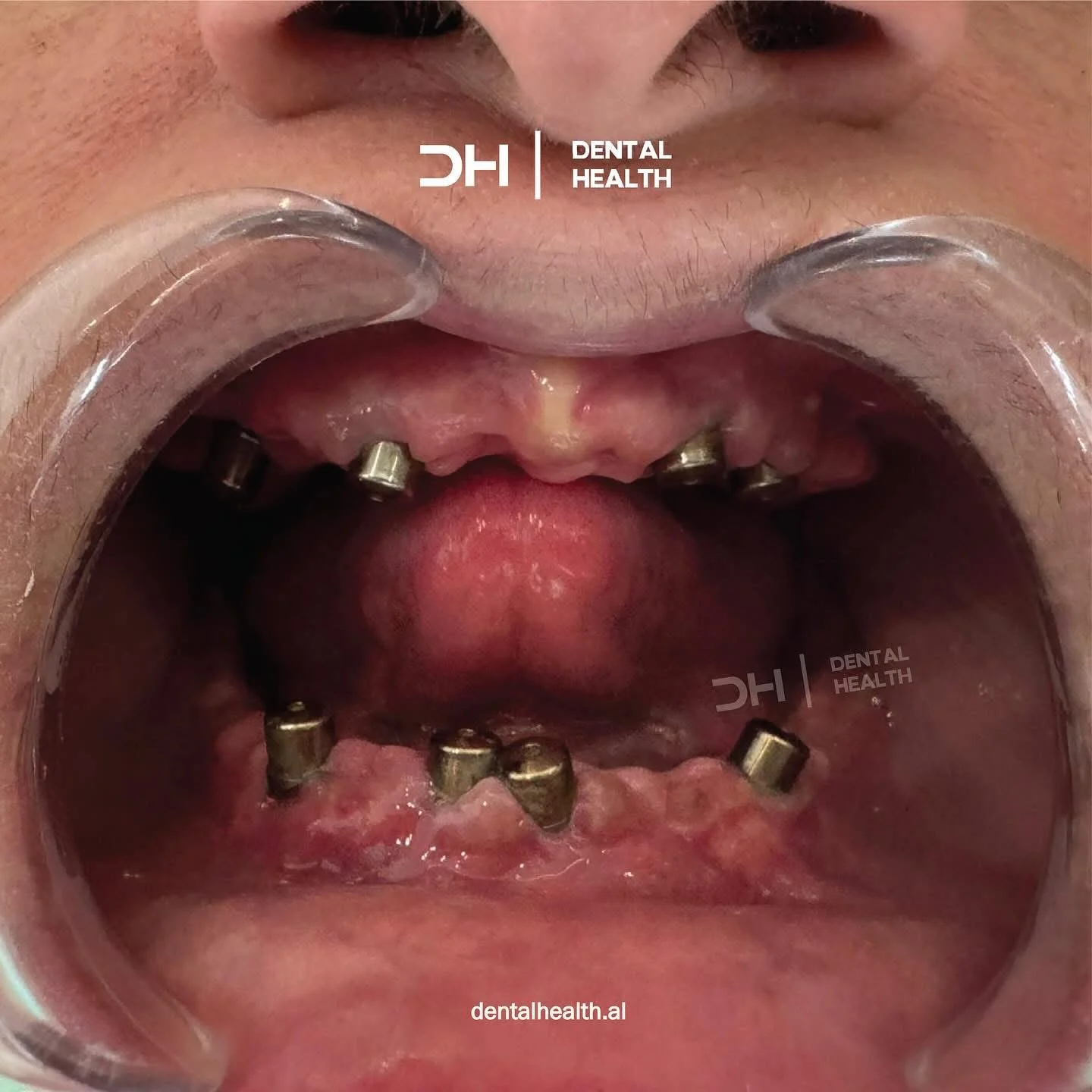 Prima - Dental implant case 3
