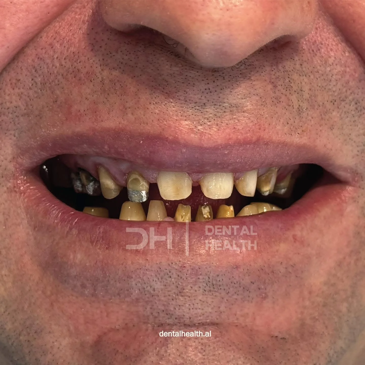 Prima - Dental implant case 4