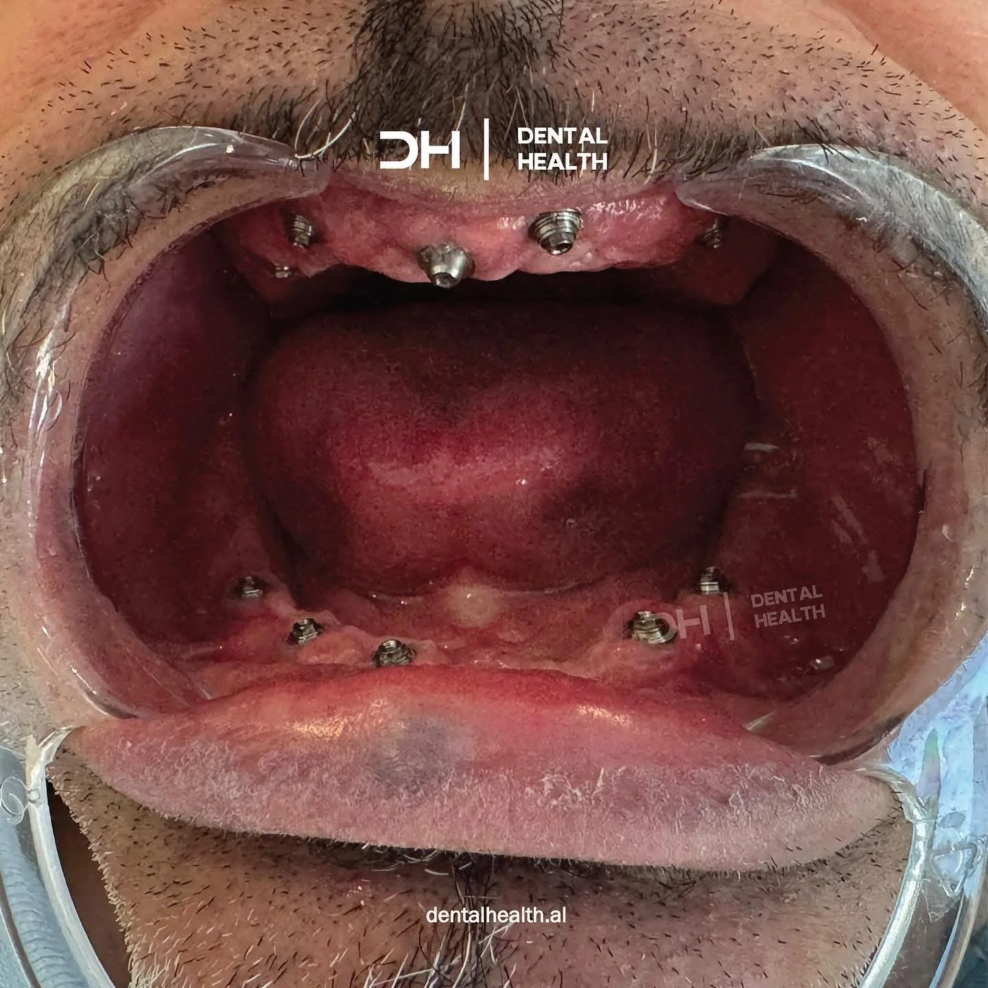 Prima - Dental implant case 5