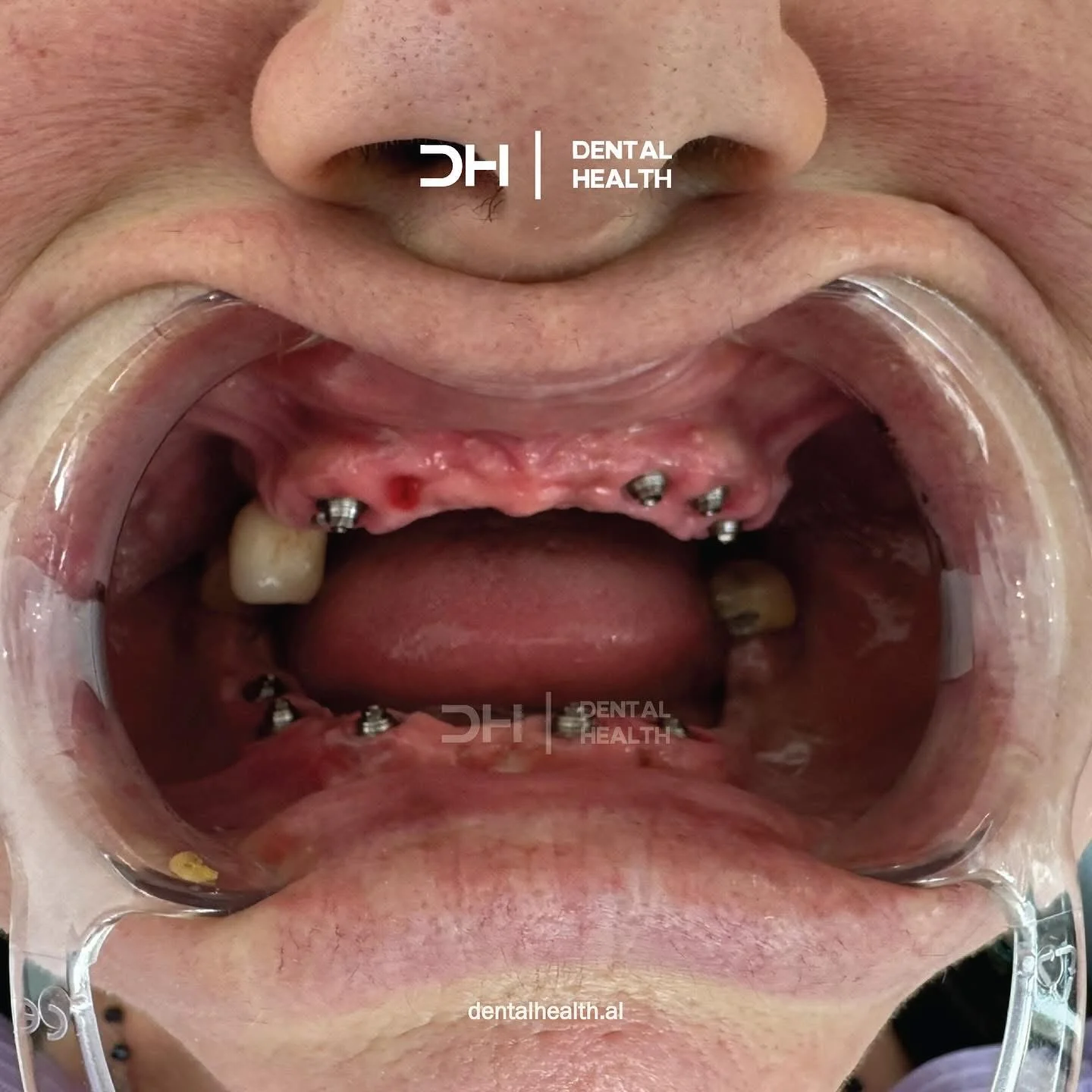 Prima - Dental implant case 6