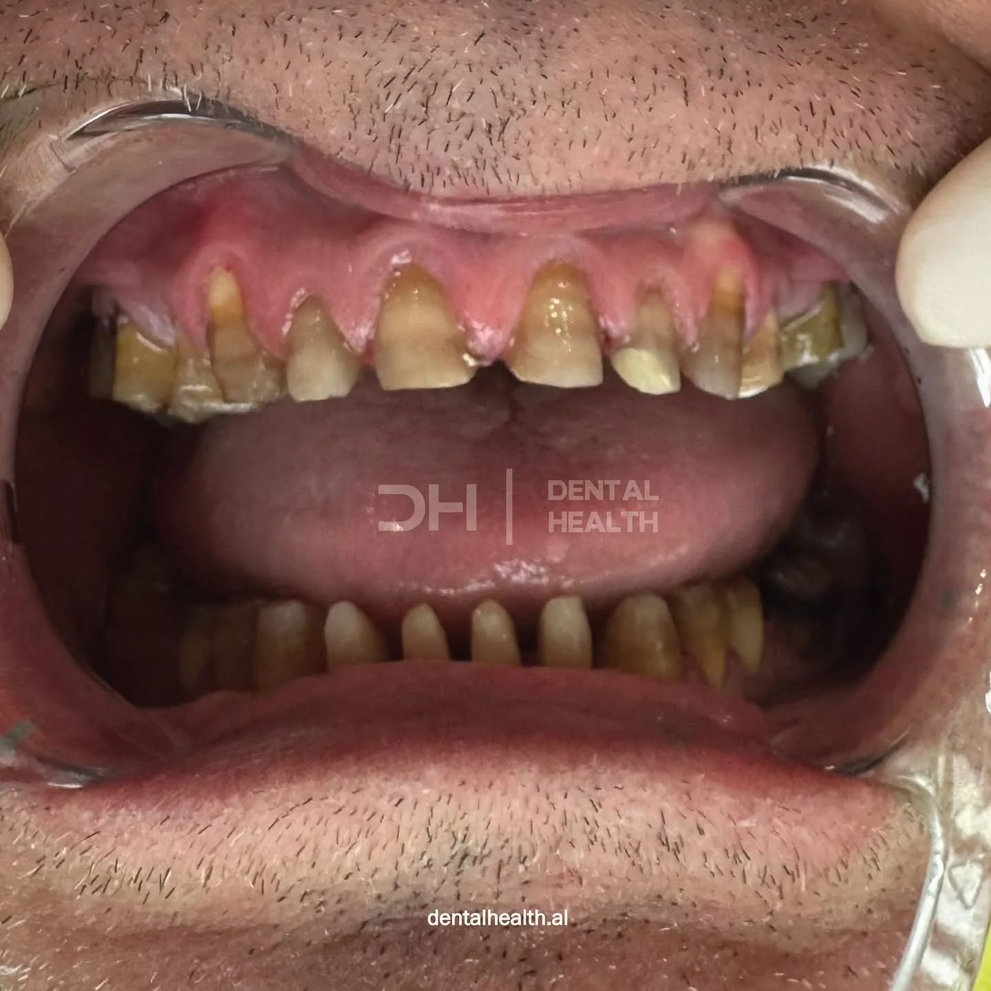 Prima - Dental implant case 7