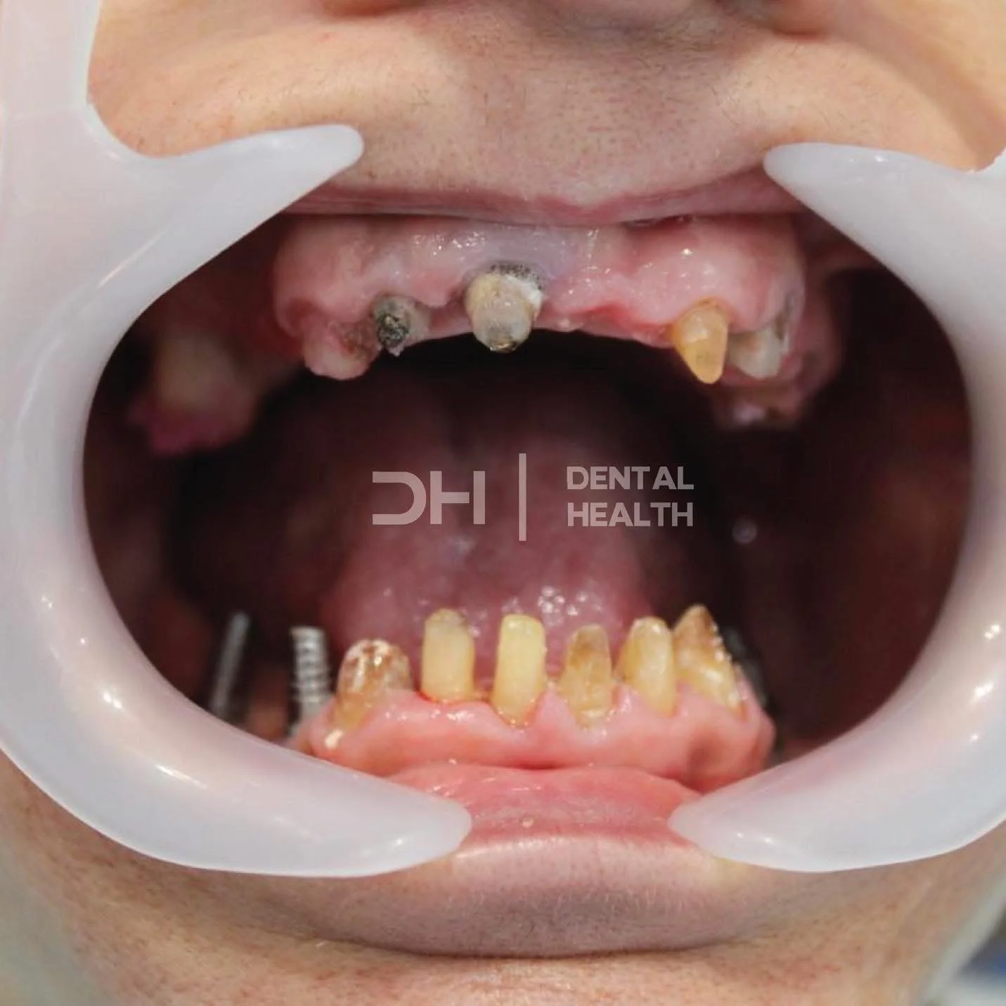 Prima - Dental implant case 8