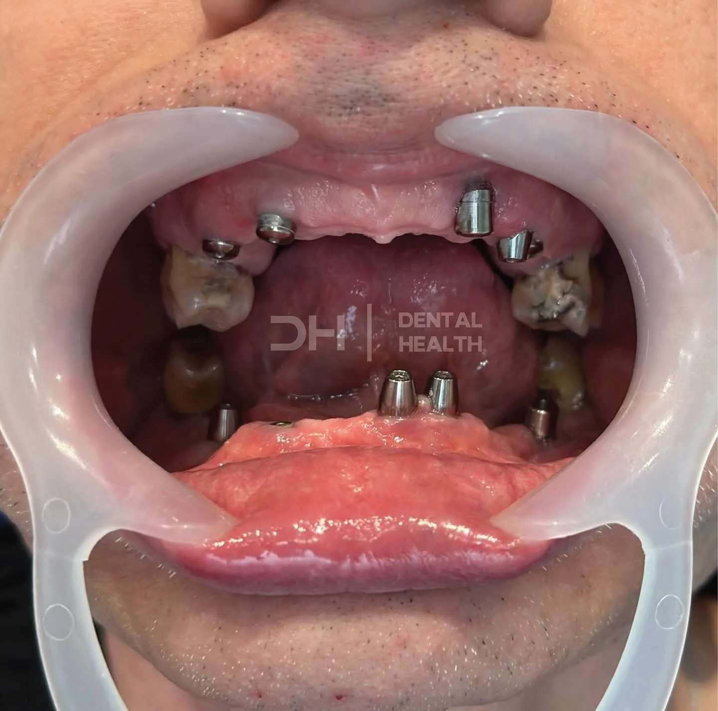 Prima - Dental implant case 9