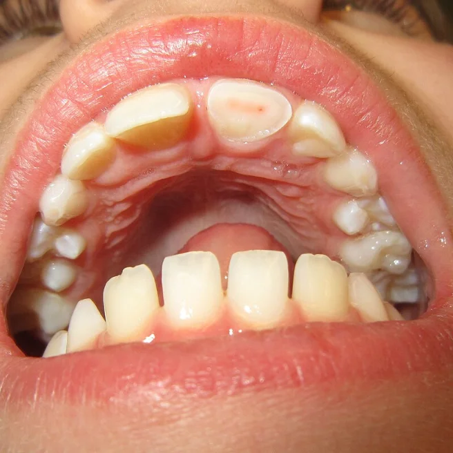 Procedura e Endodoncisë