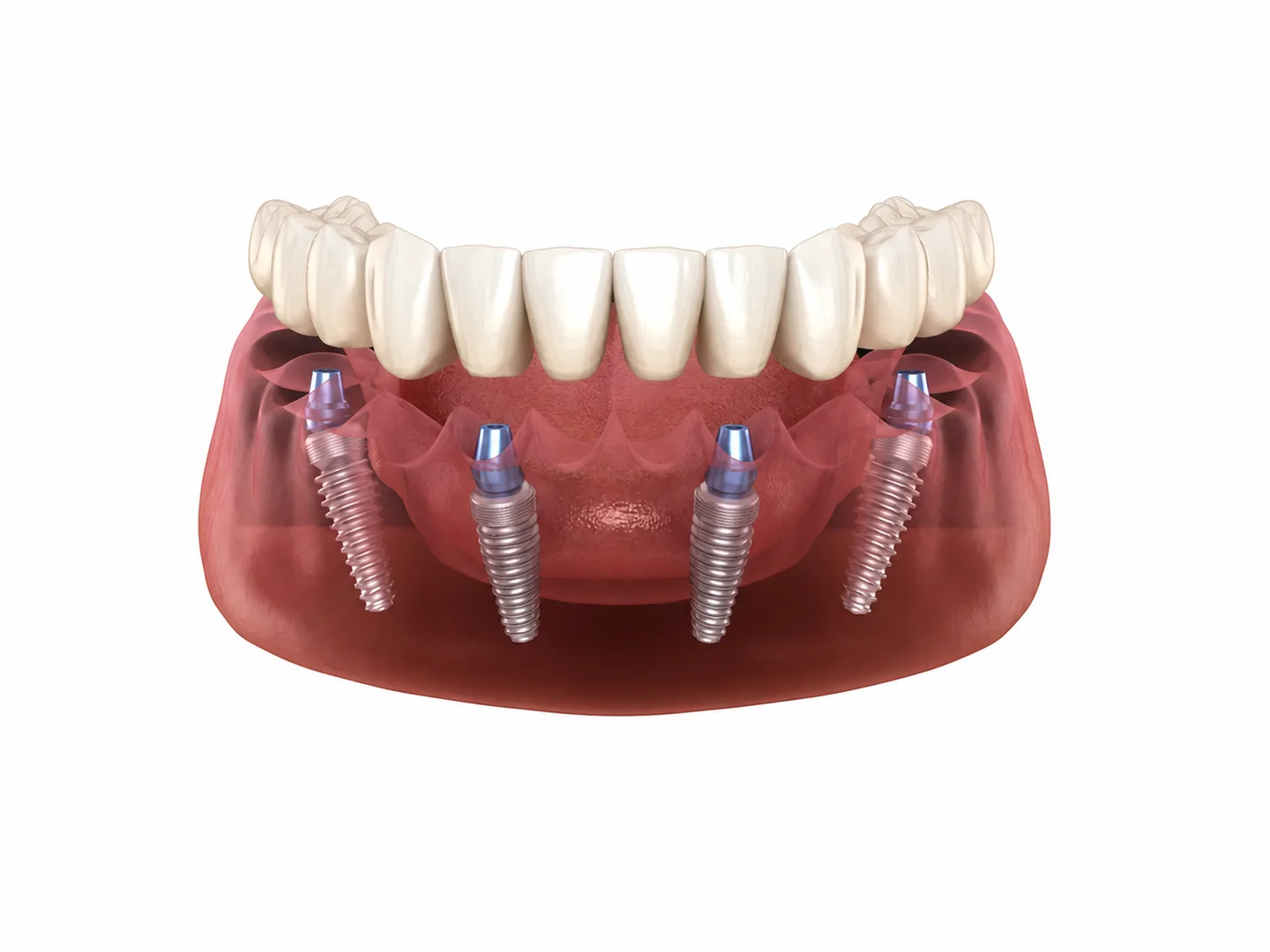 All On 4 Dental Implants