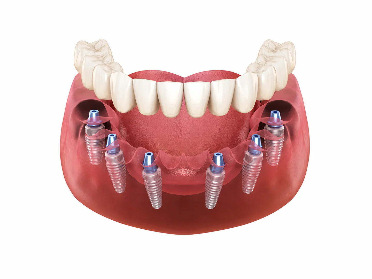 All On 6 Dental Implants
