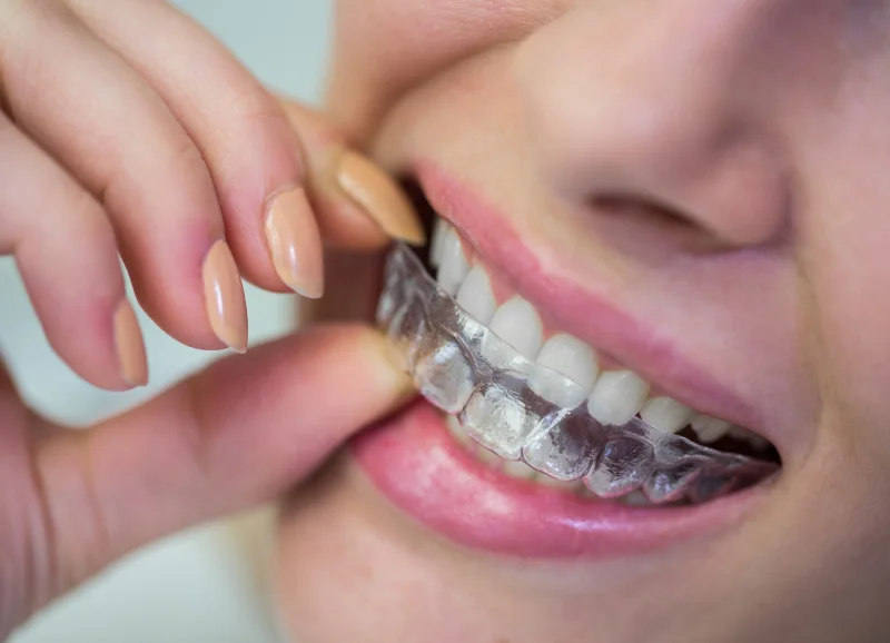 Aligners Transparentë