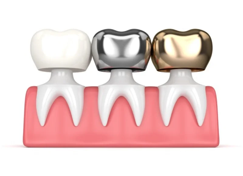Procedura e Kurorës Dentare