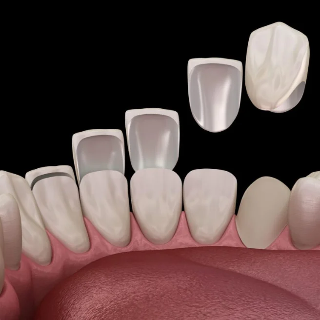 Rezultati i Kurorës Dentare